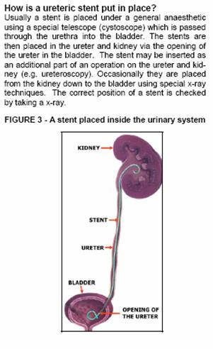 ureteric stent